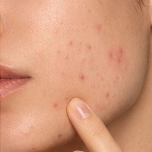 ACNE