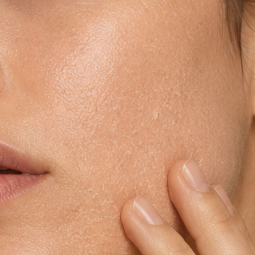 DRY SKIN